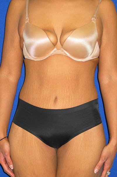 Extended Abdominoplasty Before & After Gallery - Patient 135288 - Image 2