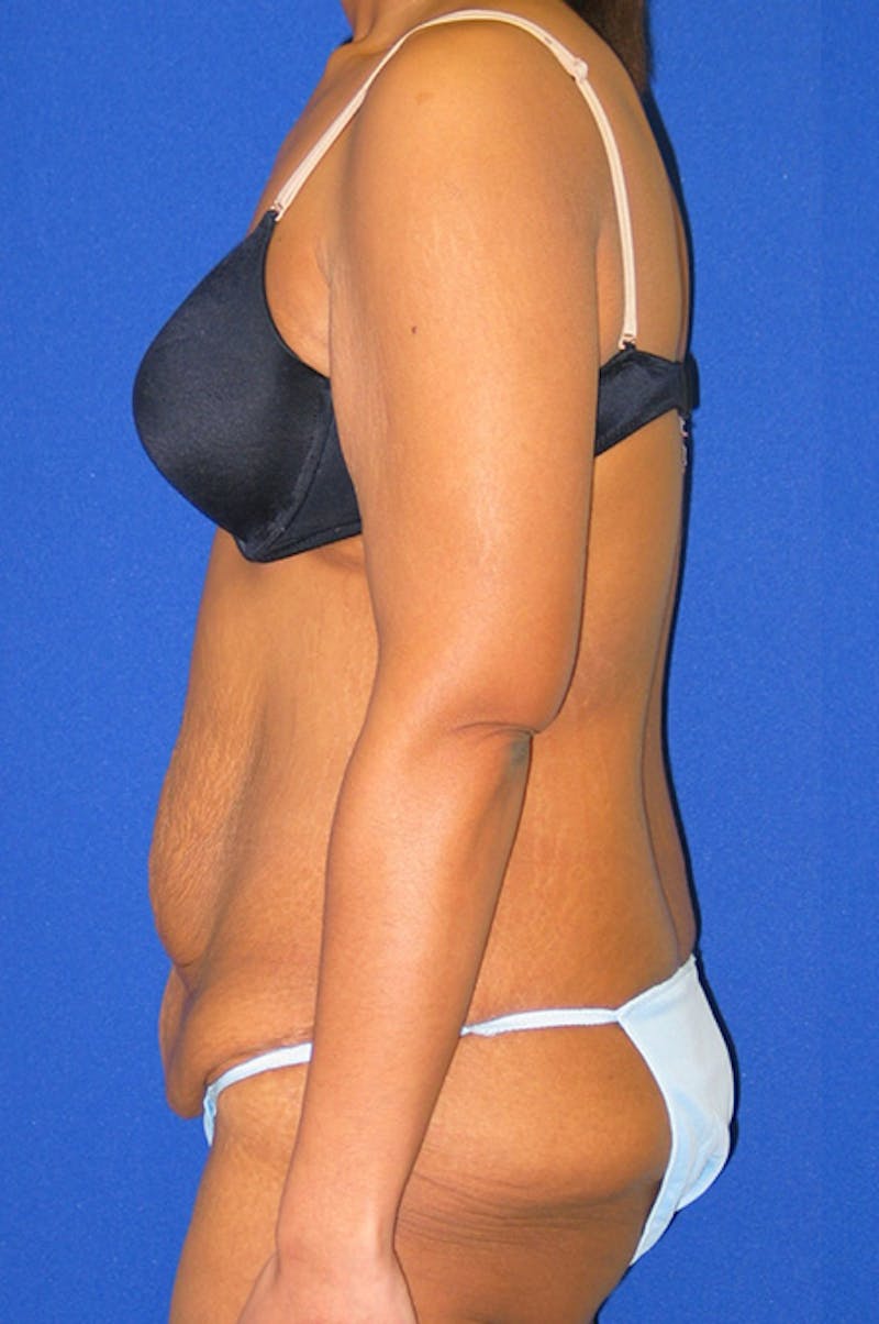 Extended Abdominoplasty Before & After Gallery - Patient 135288 - Image 5