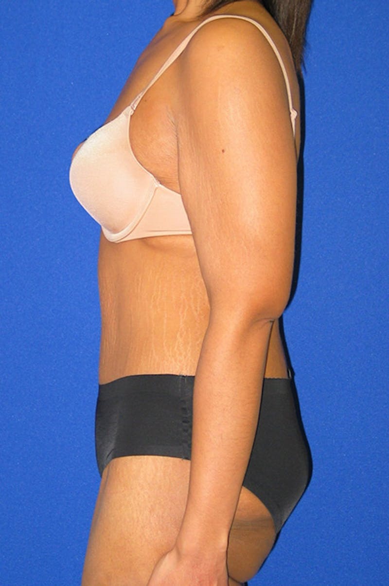 Extended Abdominoplasty Before & After Gallery - Patient 135288 - Image 6