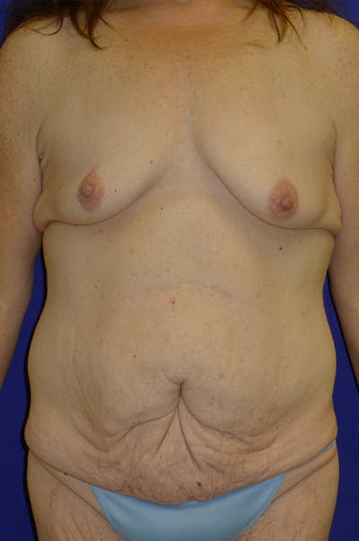 Extended Abdominoplasty Before & After Gallery - Patient 139582 - Image 1