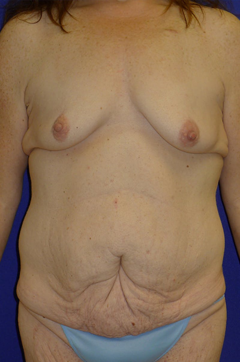Extended Abdominoplasty Before & After Gallery - Patient 139582 - Image 1