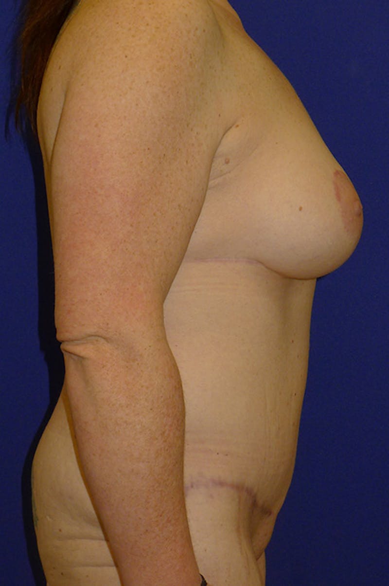 Extended Abdominoplasty Before & After Gallery - Patient 139582 - Image 4
