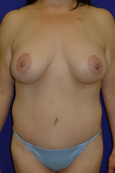 Extended Abdominoplasty Before & After Gallery - Patient 139582 - Image 2