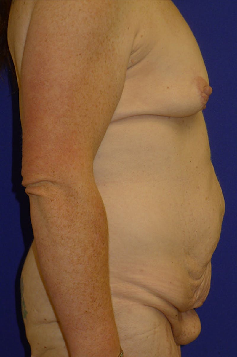 Extended Abdominoplasty Before & After Gallery - Patient 139582 - Image 3