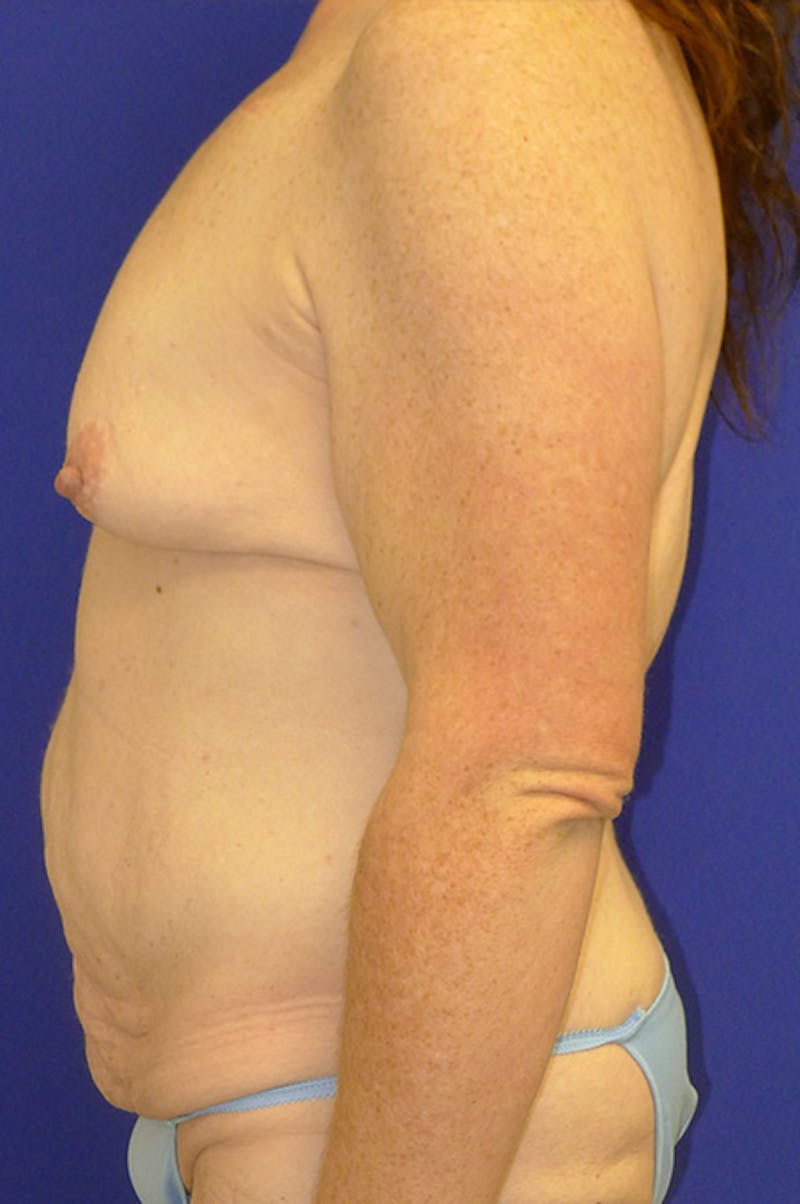Extended Abdominoplasty Before & After Gallery - Patient 139582 - Image 5