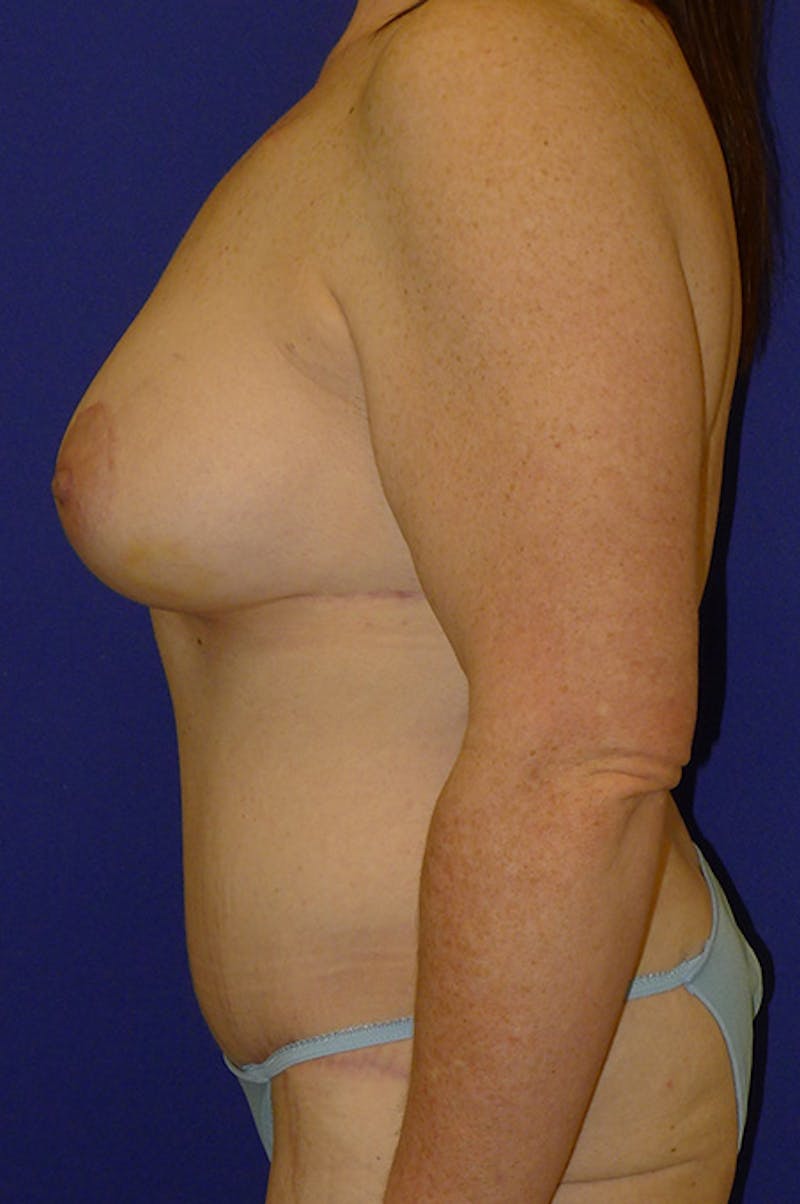 Extended Abdominoplasty Before & After Gallery - Patient 139582 - Image 6