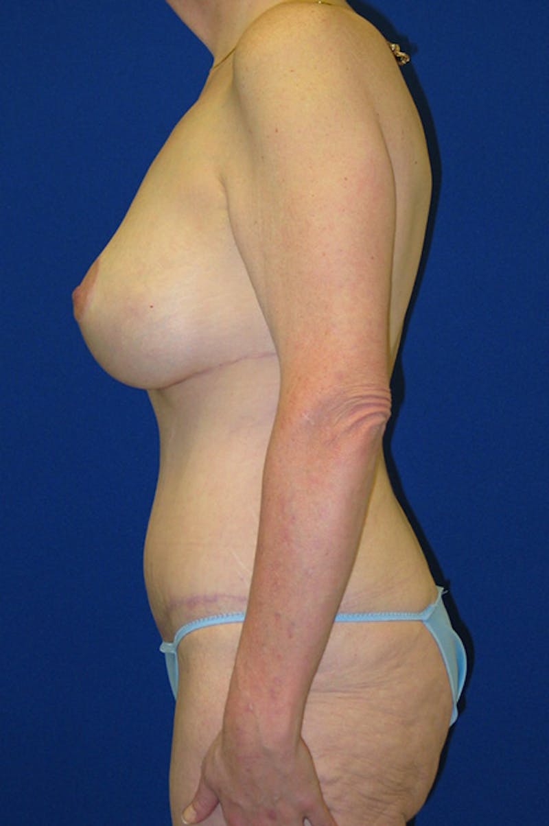 Extended Abdominoplasty Before & After Gallery - Patient 197659 - Image 6