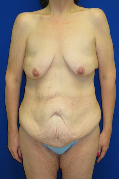 Extended Abdominoplasty Before & After Gallery - Patient 197659 - Image 1