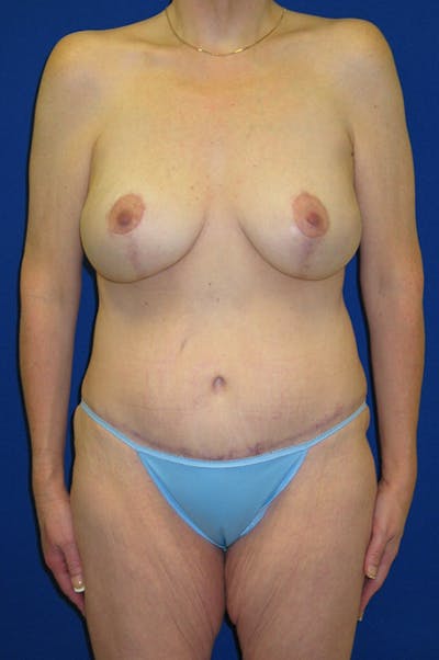 Extended Abdominoplasty Before & After Gallery - Patient 197659 - Image 2
