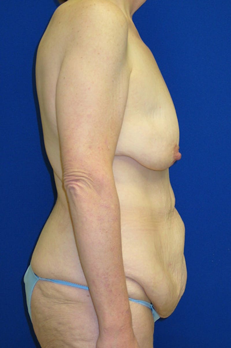 Extended Abdominoplasty Before & After Gallery - Patient 197659 - Image 3