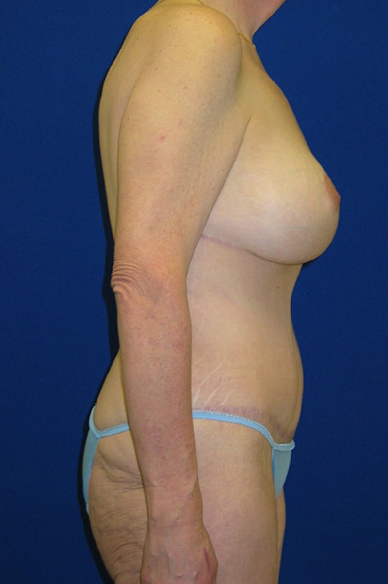Extended Abdominoplasty Before & After Gallery - Patient 197659 - Image 4