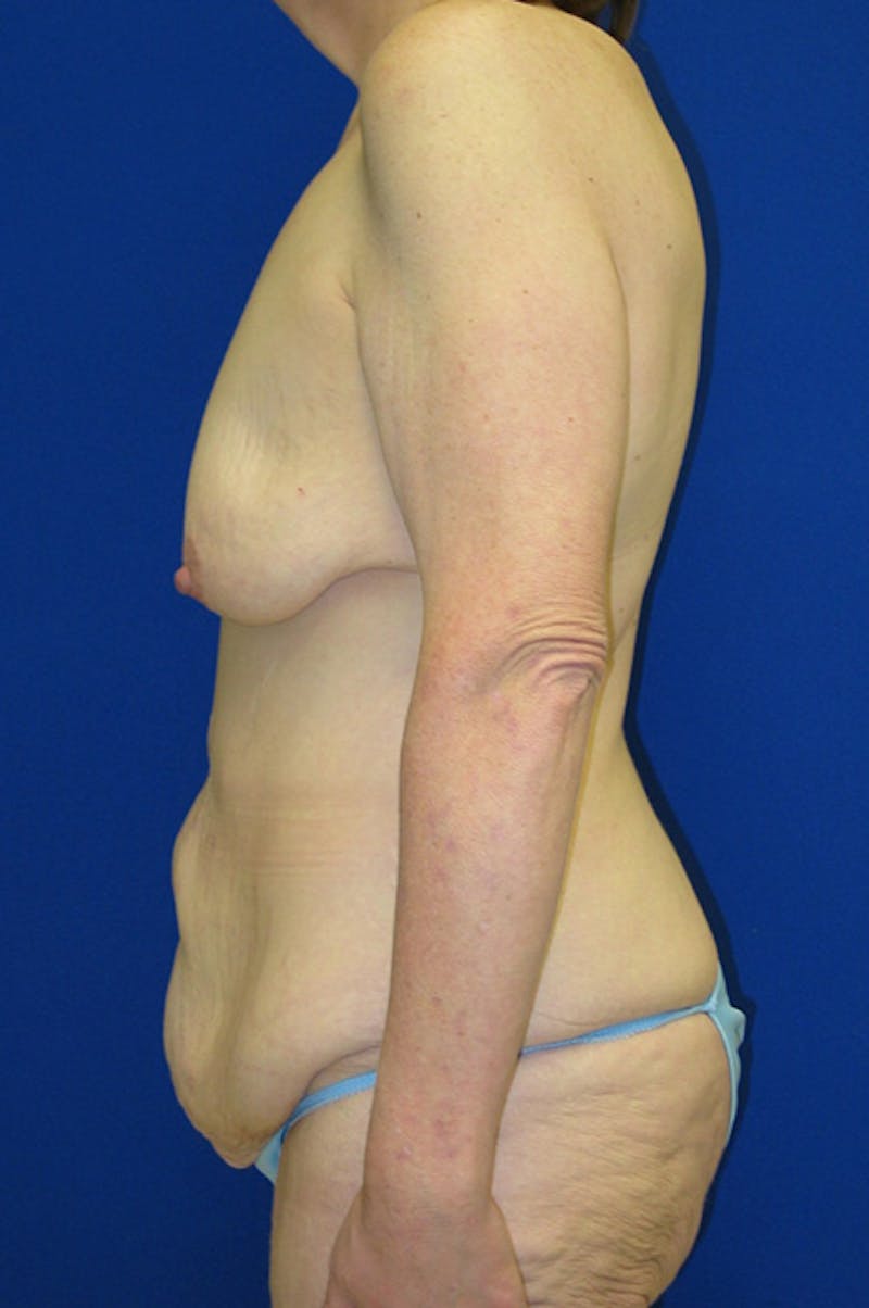 Extended Abdominoplasty Before & After Gallery - Patient 197659 - Image 5