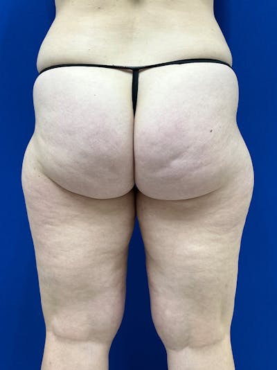Avéli Cellulite Treatment Before & After Gallery - Patient 290707 - Image 1