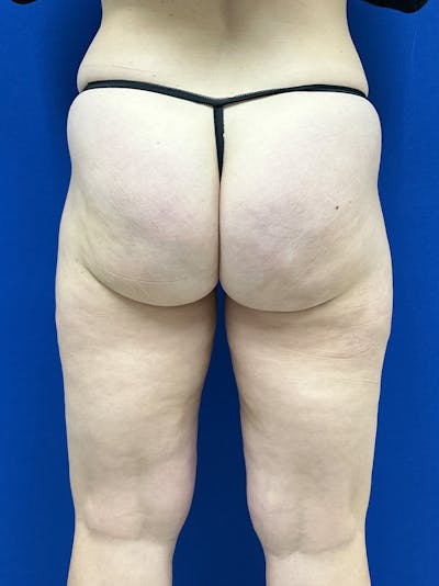 Avéli Cellulite Treatment Before & After Gallery - Patient 290707 - Image 2
