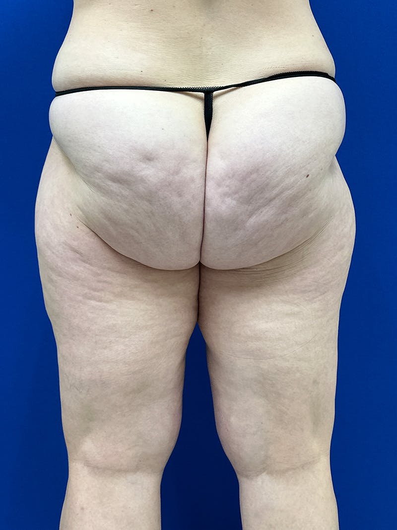 Avéli Cellulite Treatment Before & After Gallery - Patient 290707 - Image 7