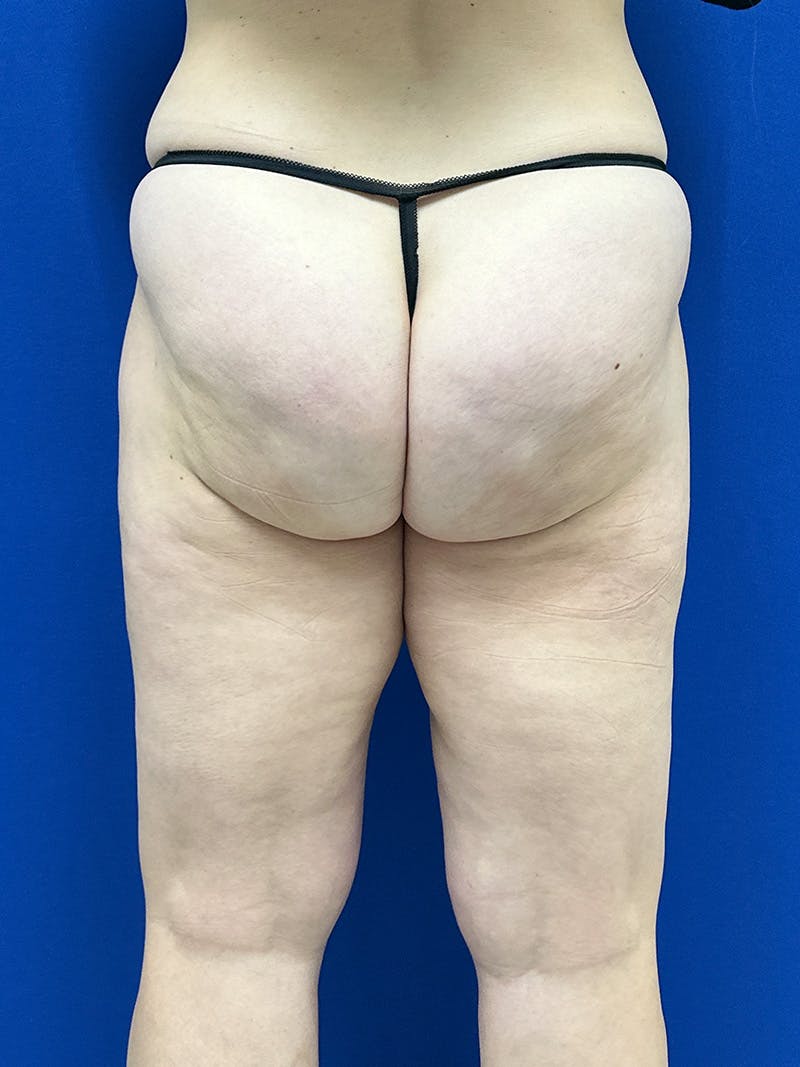 Avéli Cellulite Treatment Before & After Gallery - Patient 290707 - Image 8