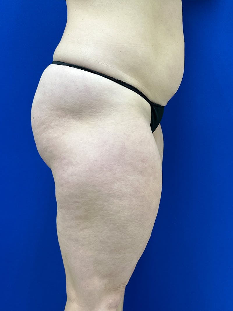 Avéli Cellulite Treatment Before & After Gallery - Patient 290707 - Image 3