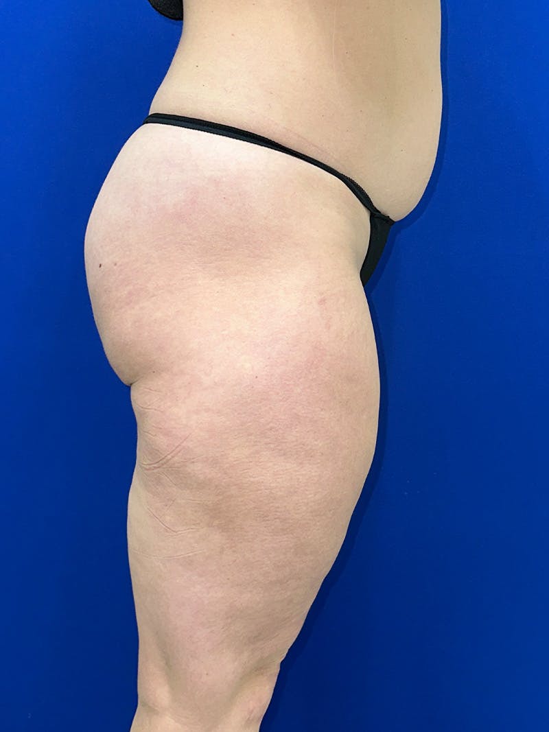 Avéli Cellulite Treatment Before & After Gallery - Patient 290707 - Image 4