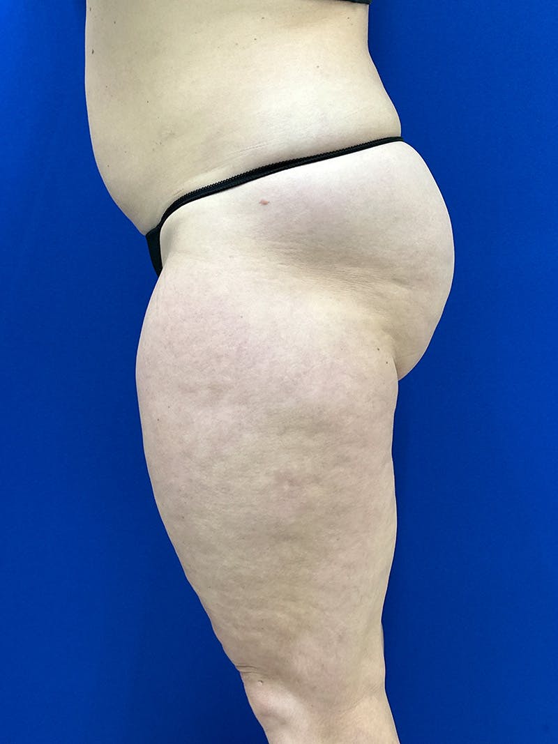 Avéli Cellulite Treatment Before & After Gallery - Patient 290707 - Image 5