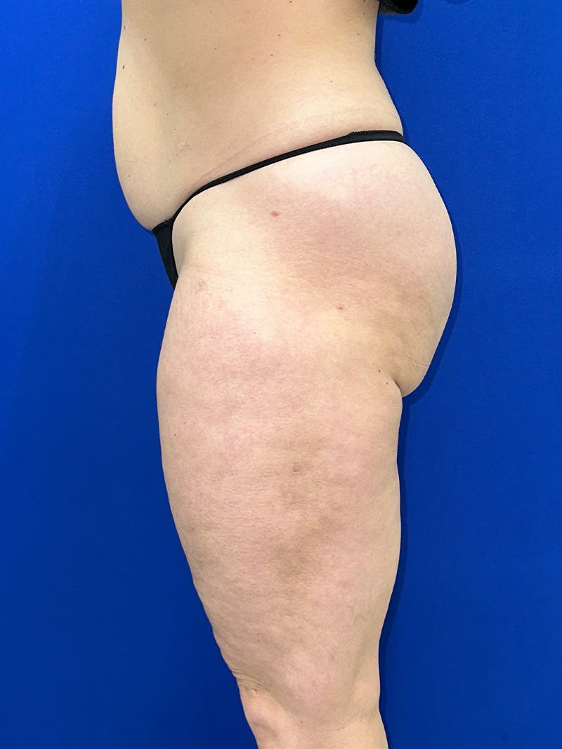 Avéli Cellulite Treatment Before & After Gallery - Patient 290707 - Image 6