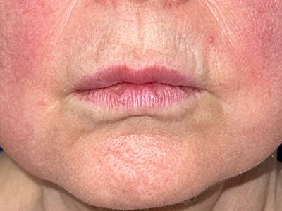 Injectable Fillers Before & After Gallery - Patient 175169061 - Image 1