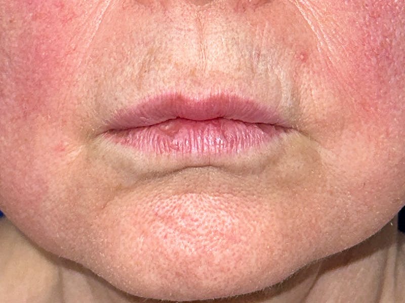 Injectable Fillers Before & After Gallery - Patient 175169061 - Image 1