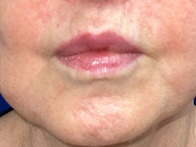 Injectable Fillers Before & After Gallery - Patient 175169061 - Image 2