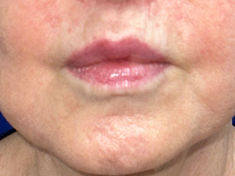 Injectable Fillers Before & After Gallery - Patient 175169061 - Image 2