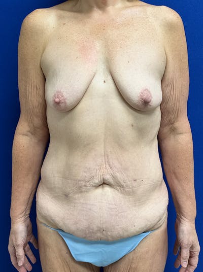 Breast Before & After Gallery - Patient 350495 - Image 1