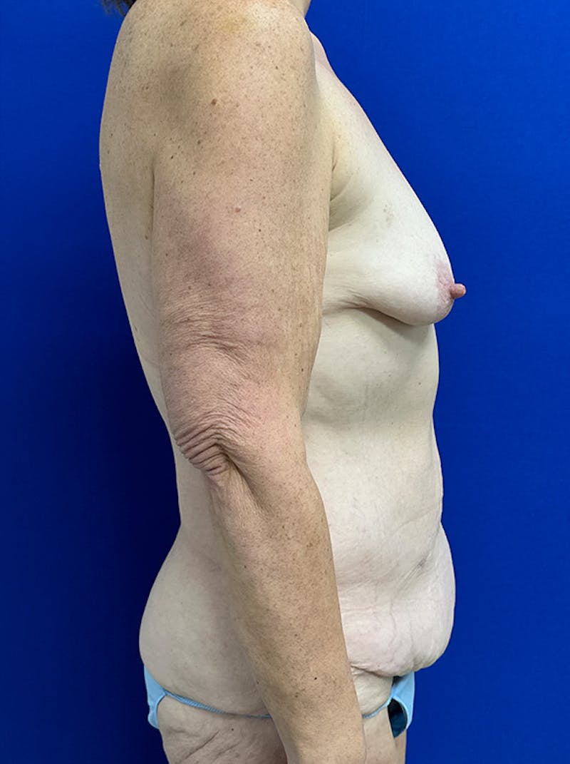 Extended Abdominoplasty Before & After Gallery - Patient 859761 - Image 3