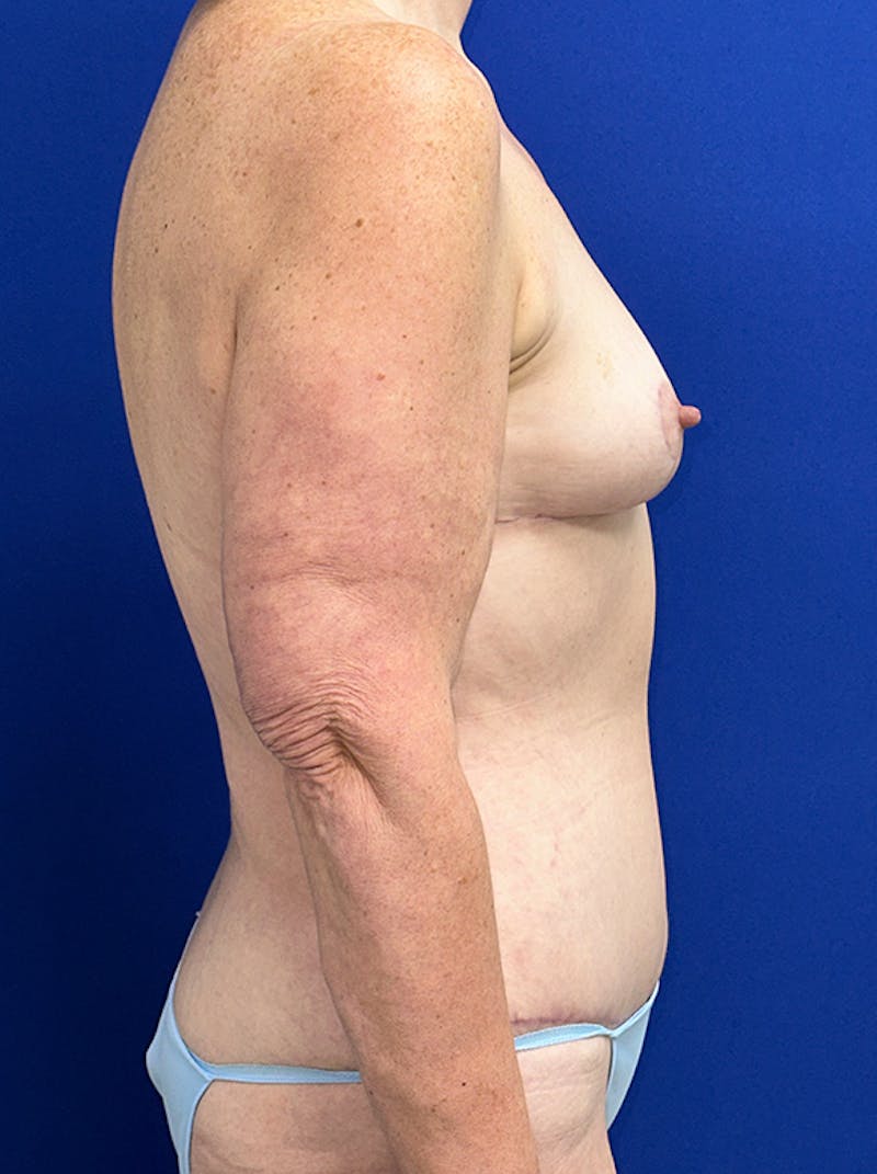 Extended Abdominoplasty Before & After Gallery - Patient 859761 - Image 4