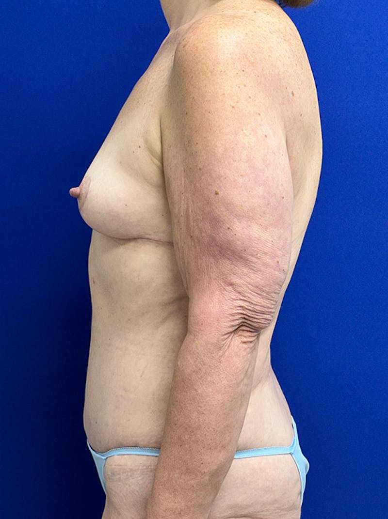 Extended Abdominoplasty Before & After Gallery - Patient 859761 - Image 6