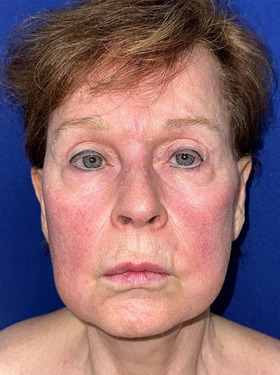 Lip Lift Before & After Gallery - Patient 365553 - Image 1