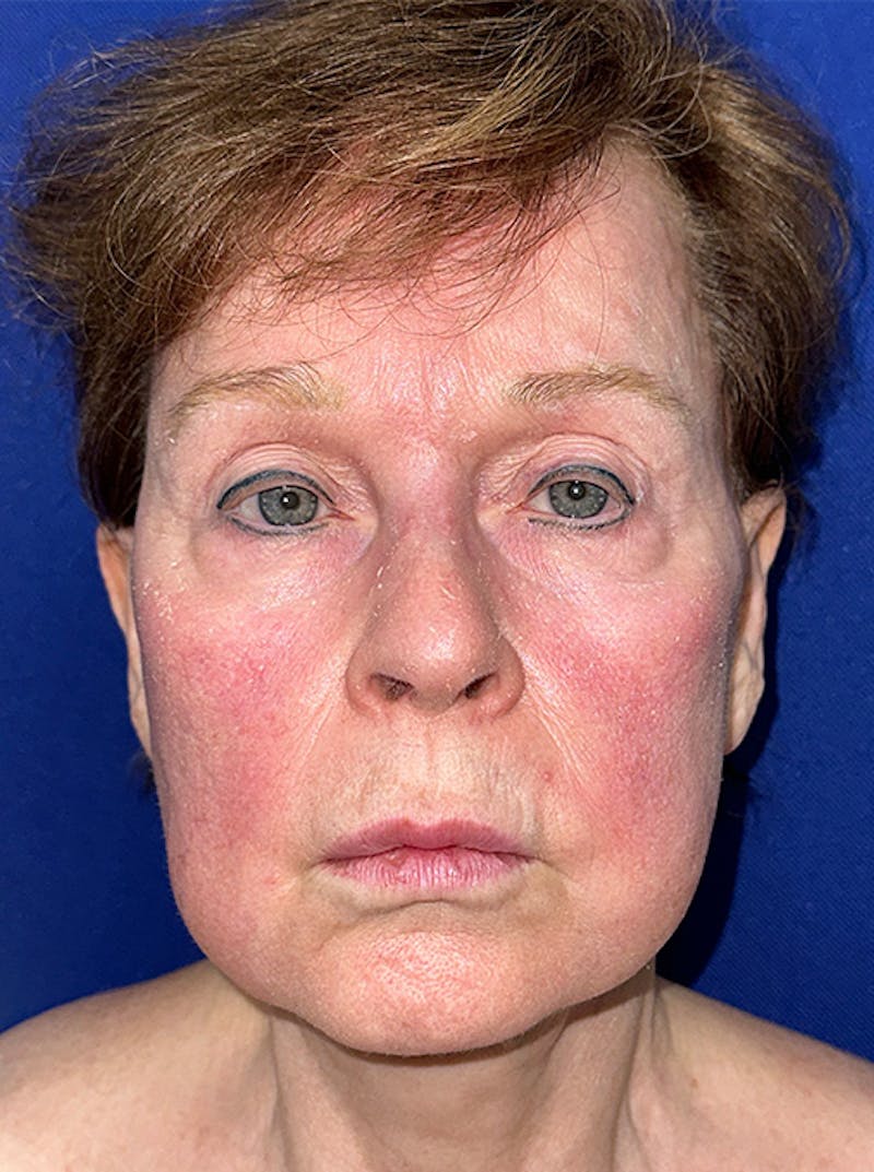 Lip Lift Before & After Gallery - Patient 365553 - Image 1