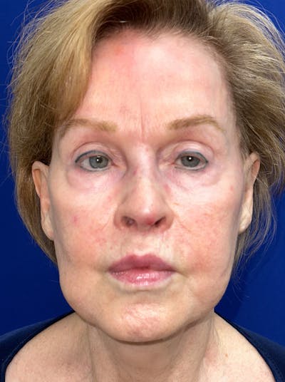 Lip Lift Before & After Gallery - Patient 365553 - Image 2