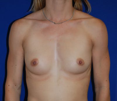 Augmentation Before & After Gallery - Patient 213385 - Image 1