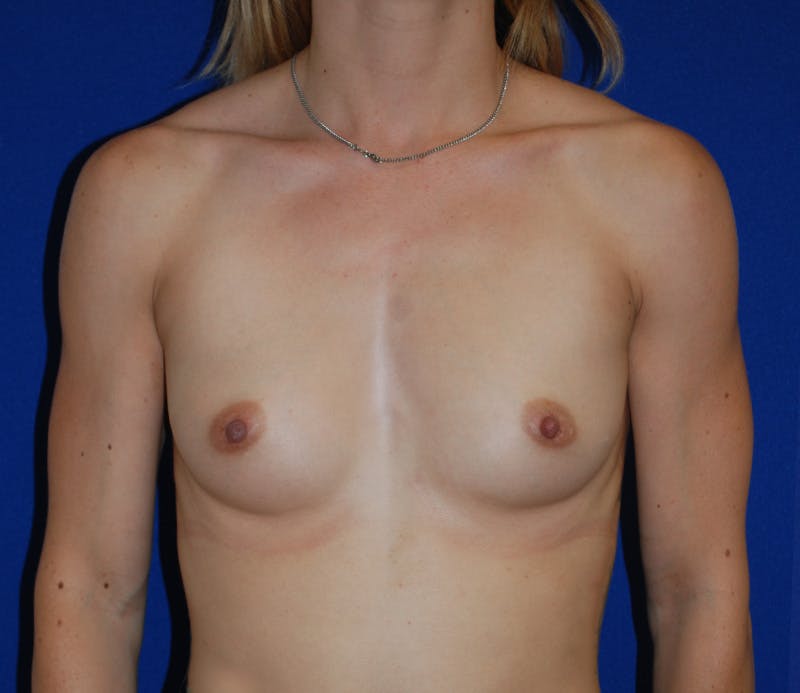 Augmentation Before & After Gallery - Patient 213385 - Image 1