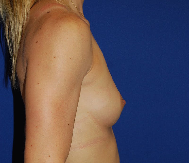 Augmentation Before & After Gallery - Patient 213385 - Image 3