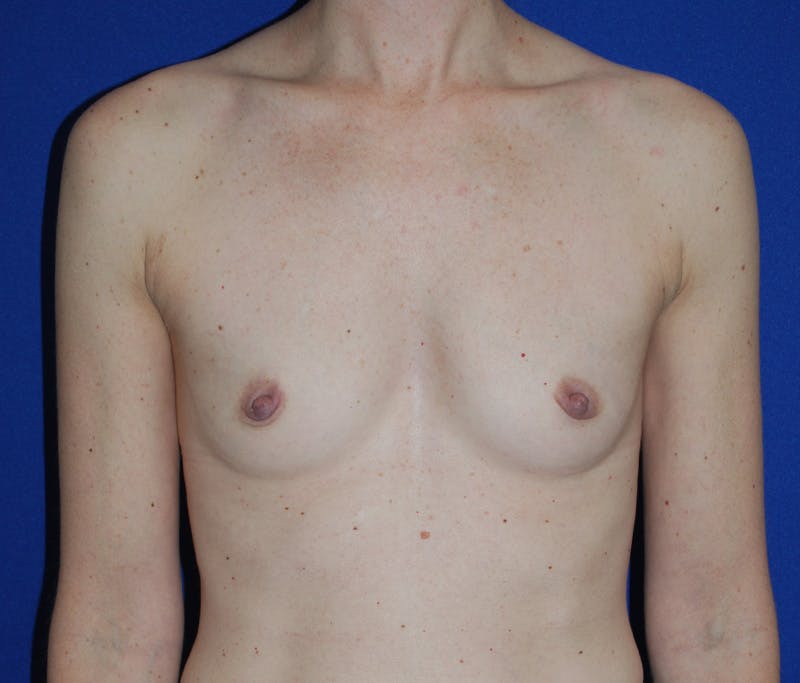Augmentation Before & After Gallery - Patient 413694 - Image 1
