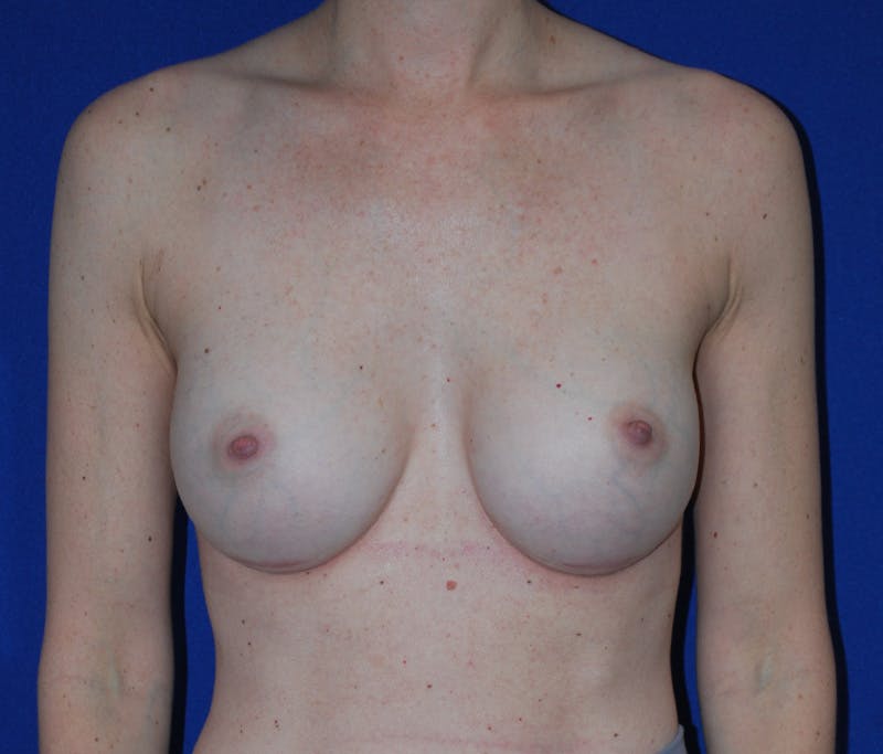 Augmentation Before & After Gallery - Patient 413694 - Image 2