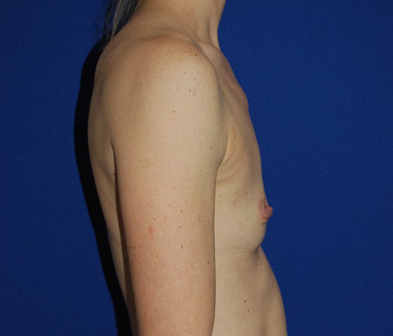 Augmentation Before & After Gallery - Patient 413694 - Image 3