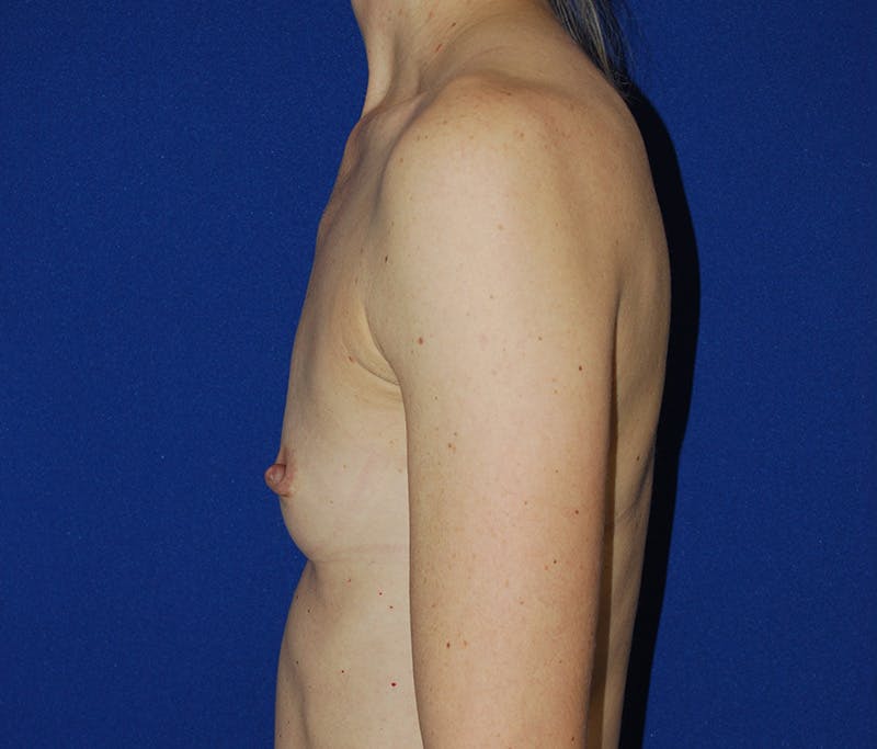 Augmentation Before & After Gallery - Patient 413694 - Image 5
