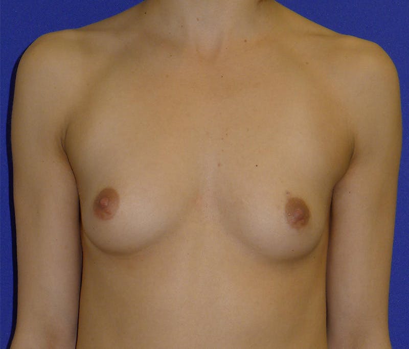 Augmentation Before & After Gallery - Patient 192167 - Image 1