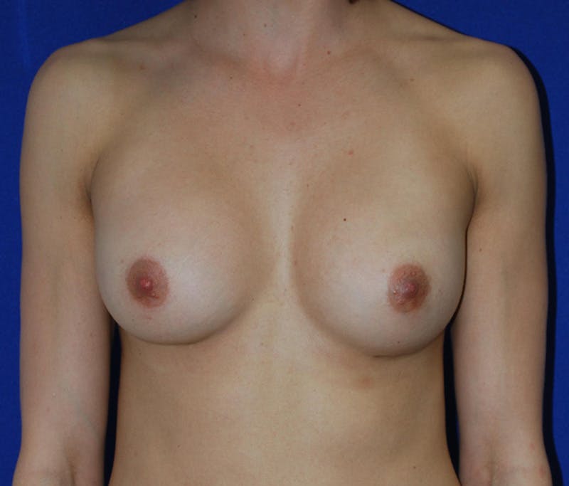 Augmentation Before & After Gallery - Patient 192167 - Image 2