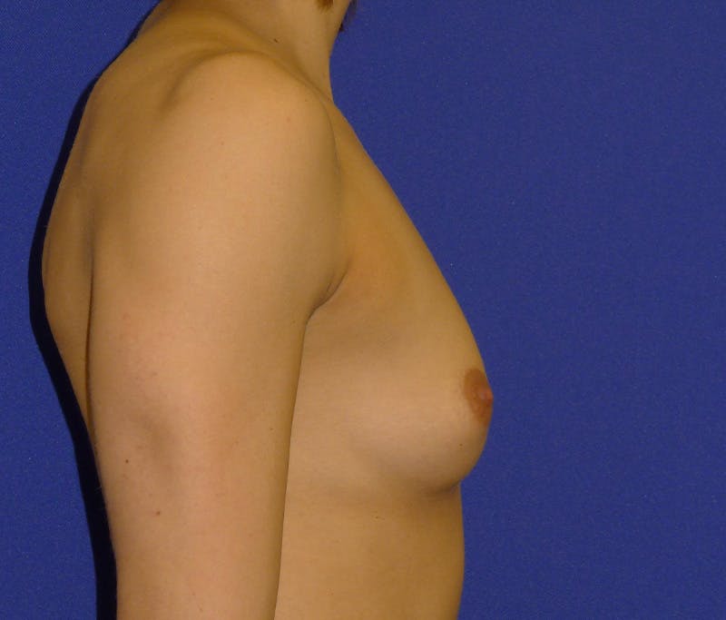 Augmentation Before & After Gallery - Patient 192167 - Image 3