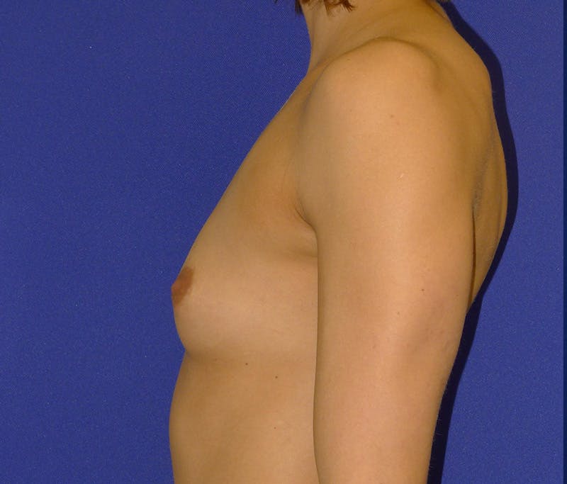 Augmentation Before & After Gallery - Patient 192167 - Image 5