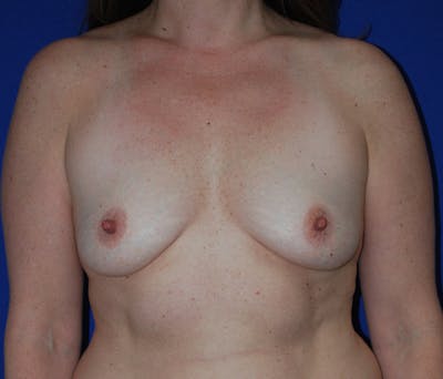Augmentation Before & After Gallery - Patient 168175 - Image 1