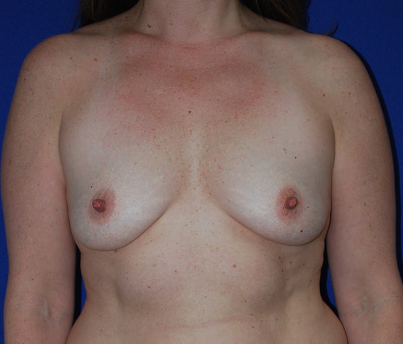Augmentation Before & After Gallery - Patient 168175 - Image 1
