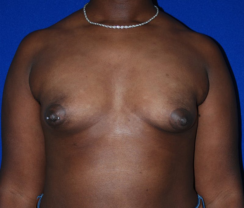 Augmentation Before & After Gallery - Patient 309572 - Image 1