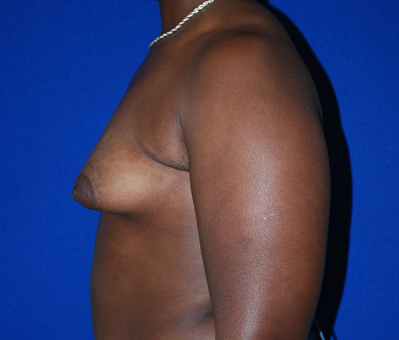 Augmentation Before & After Gallery - Patient 309572 - Image 5